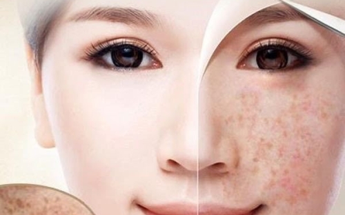 Giải Pháp Điều Trị Tàn Nhang Đồng Xoài Tận Gốc Không Tái Phát – Bí Quyết Da Đẹp Tự Nhiên Từ Spa Như Ý