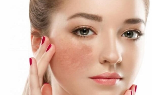 Tìm Hiểu Phương Pháp Điều Trị Nám Đồng Xoài An Toàn Và Hiệu Quả Tại Spa Như Ý