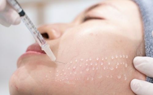 Tiêm Meso Đồng Xoài – Làm Đẹp Chuẩn Y Khoa, Da Căng Mướt Không Cần Nghỉ Dưỡng