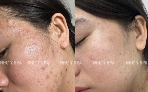 Điều Trị Mụn Lưng Đồng Xoài Hiệu Quả Chuẩn Y Khoa Tại Spa Như Ý