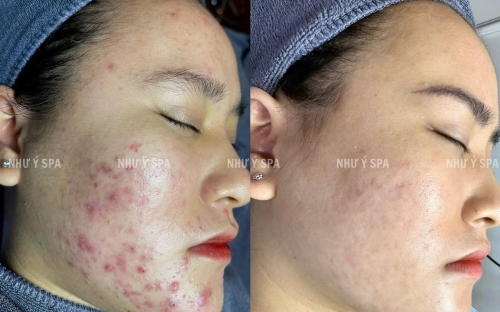 Điều Trị Mụn Đồng Xoài Chuẩn Y Khoa Tại Spa Như Ý – Giải Pháp An Toàn, Hiệu Quả Dành Cho Mọi Loại Da