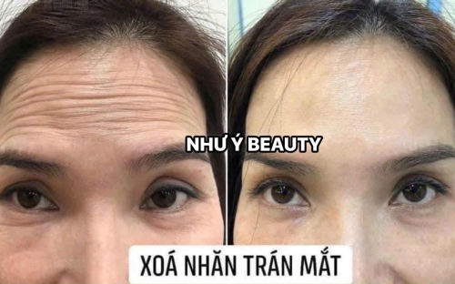 Xóa nhăn – Trẻ hóa da không xâm lấn tại Spa Như Ý | Spa Đồng Xoài uy tín