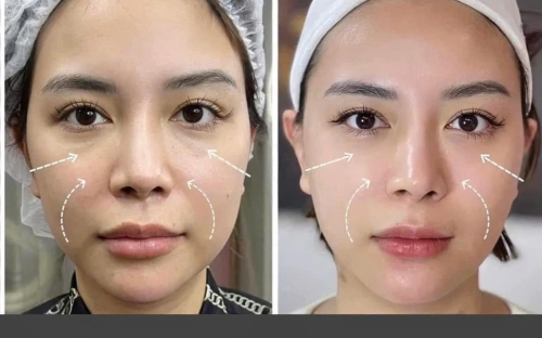 Tiêm BAP Nâng Cơ – Trẻ Hóa Da Không Xâm Lấn | Spa Như Ý – Spa Đồng Xoài Uy Tín