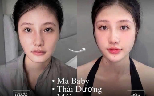 Tiêm Botox Full Face Trẻ Hóa – Căng Da Không Cần Phẫu Thuật | Spa Như Ý – Spa Đồng Xoài Uy Tín