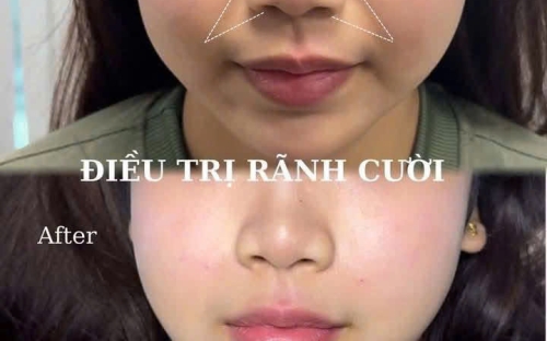 Xóa Rãnh Cười Không Phẫu Thuật Tại Spa Như Ý – Spa Đồng Xoài Uy Tín, An Toàn