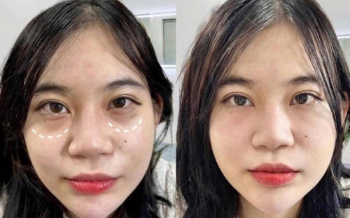 Meso Trị Thâm Mắt Hiệu Quả Không Cần Phẫu Thuật | Spa Đồng Xoài – Spa Như Ý