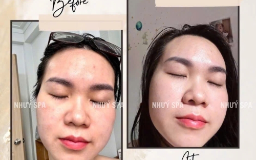 Meso Trắng Da Căng Bóng Chuẩn Y Khoa Tại Spa Như Ý – Spa Đồng Xoài Uy Tín