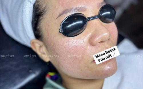 Tiêm Meso Botox Trẻ Hóa Da Không Cần Dao Kéo – Dịch Vụ Tại Spa Đồng Xoài Uy Tín