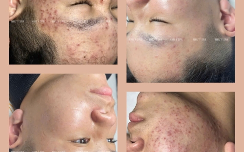 Spa Như Ý - Chuyên Trị Mụn Đồng Xoài Chuẩn Y Khoa, Hiệu Quả An Toàn