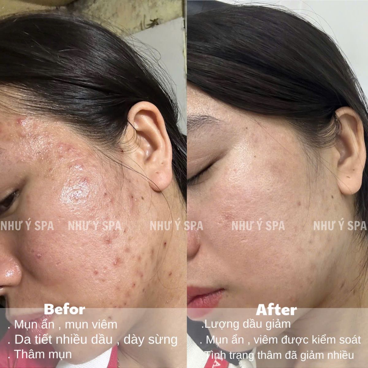 spa tri mun dong xoai